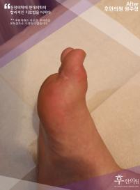 치료 후