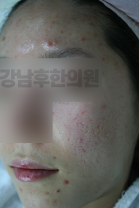 치료 전