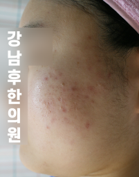 치료 전