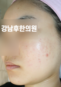 치료 후