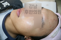 치료 후