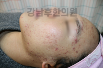 치료 전