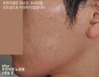 치료 후