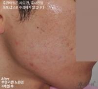 치료 후