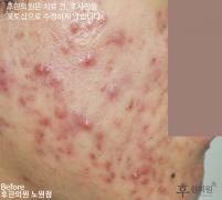 치료 전