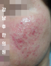 치료 후