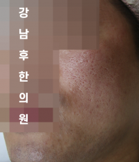 치료 전