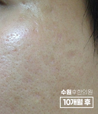 전후사진