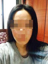 치료 전