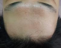 치료 후