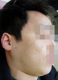 치료 후
