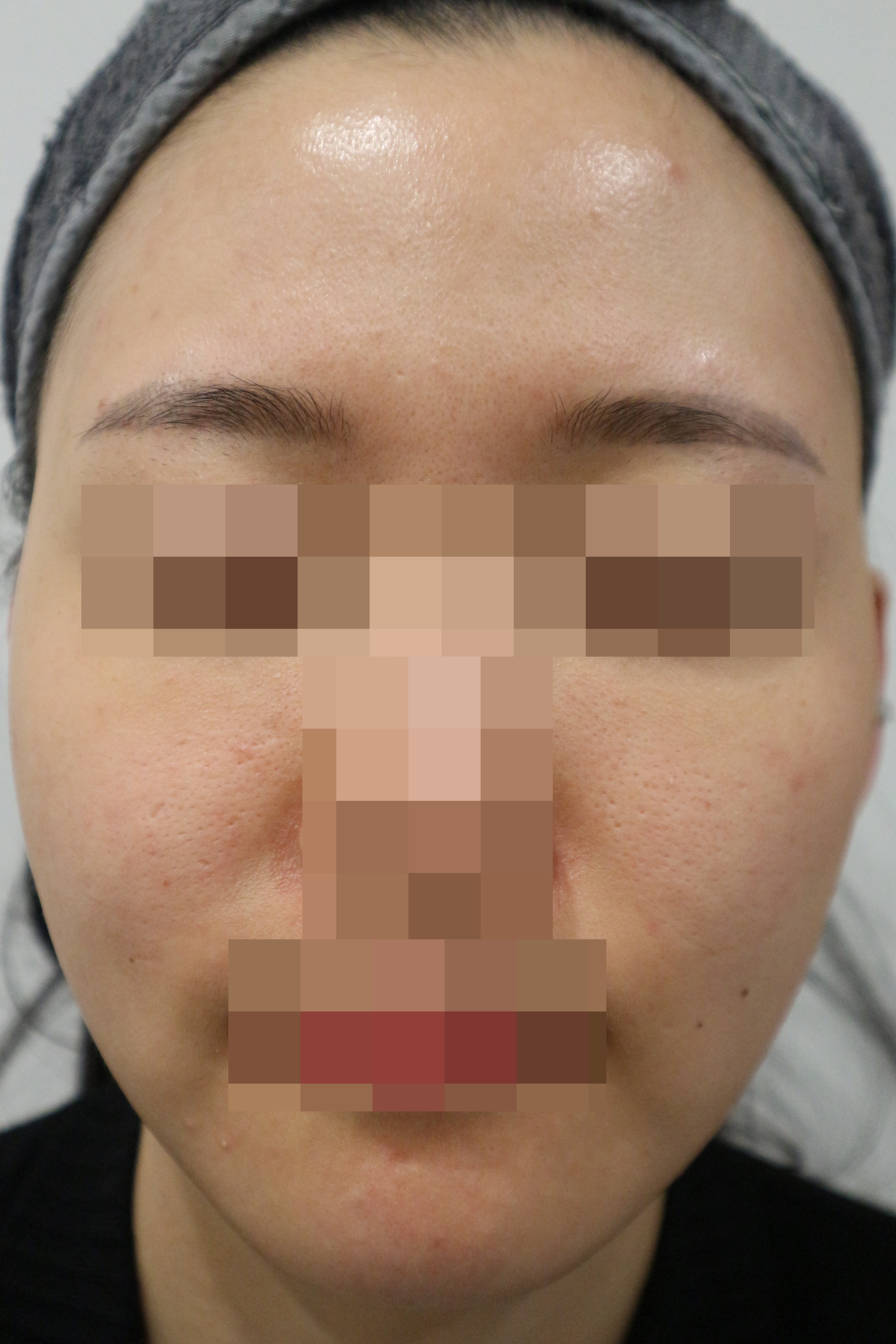 전후사진