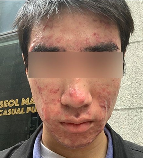 치료 전