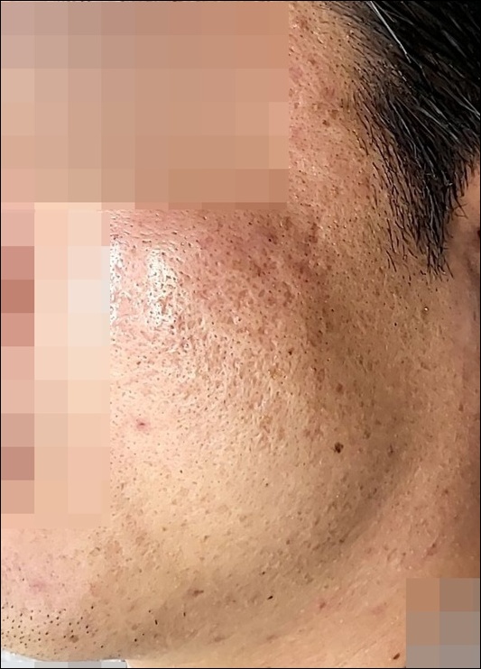 광주점 치료 전