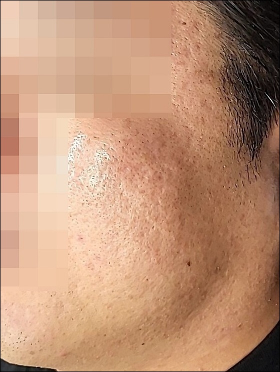 광주점 치료 후