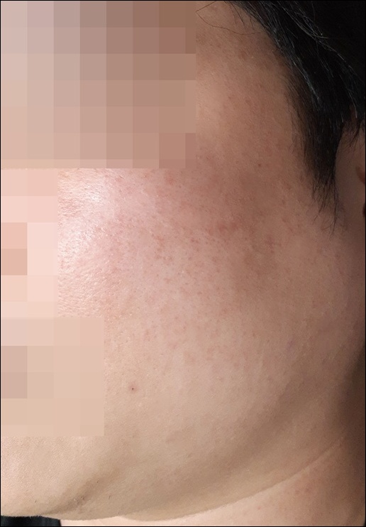 광주점 치료 후