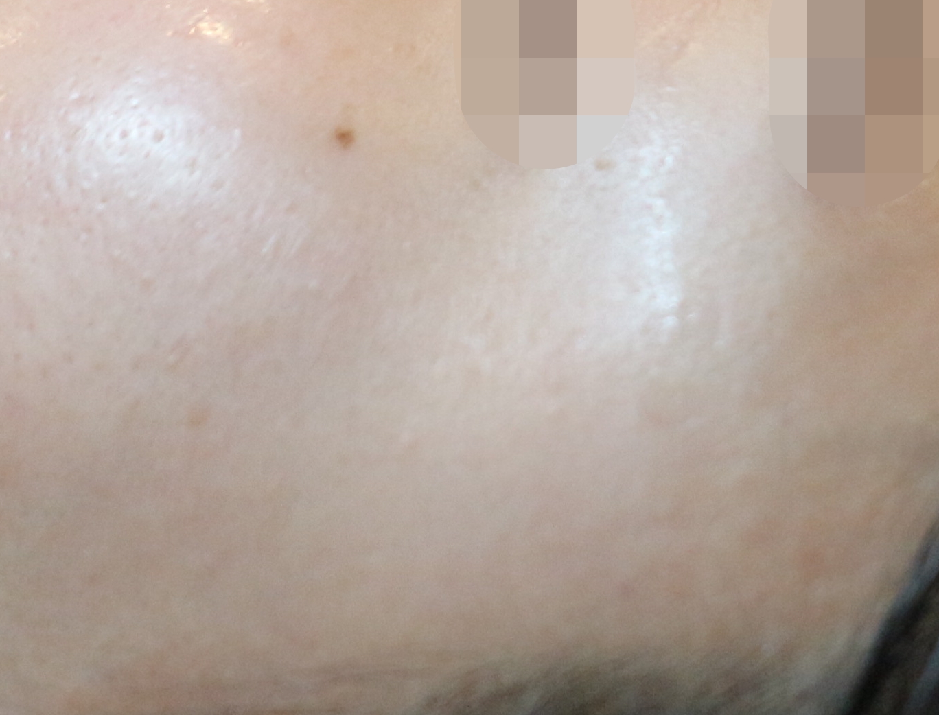 부천점 치료 후