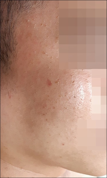 광주점 치료 전