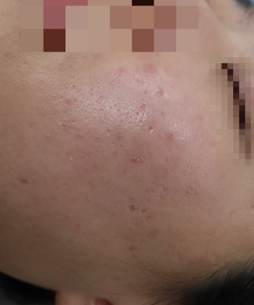 원주점 치료 전