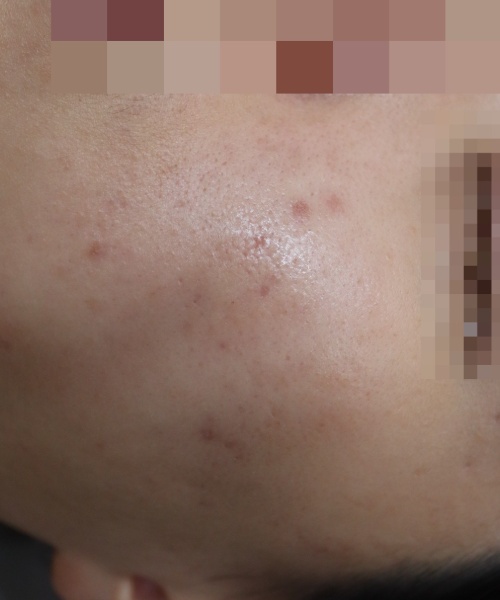 원주점 치료 후