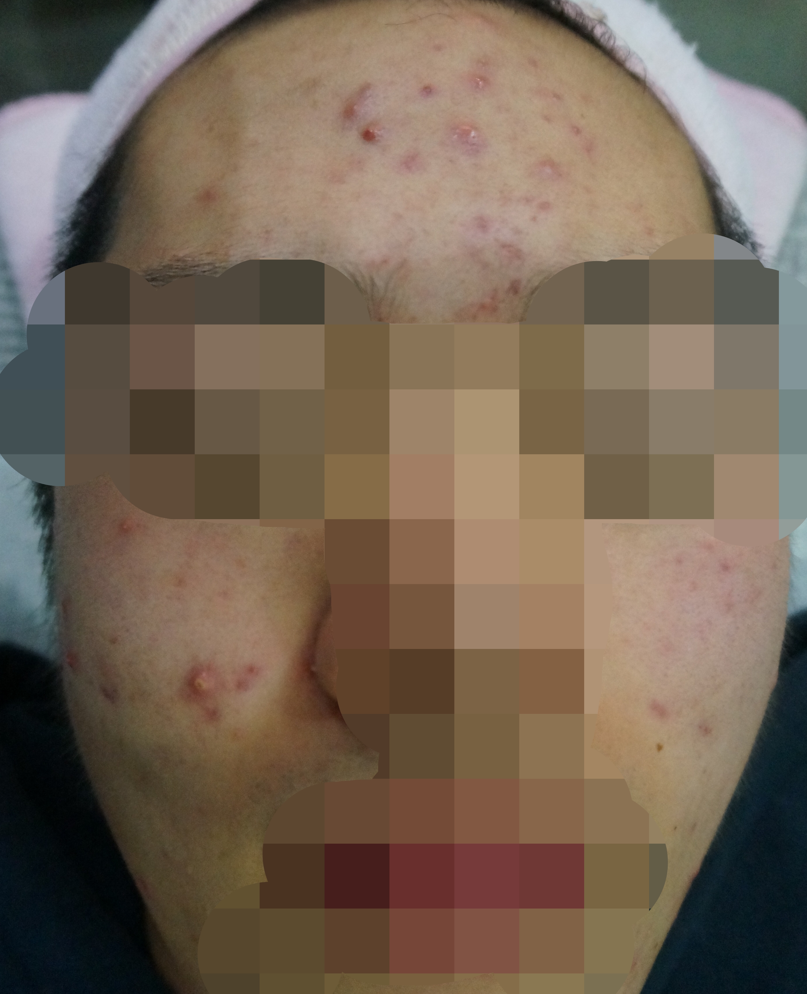 제주점 치료 전