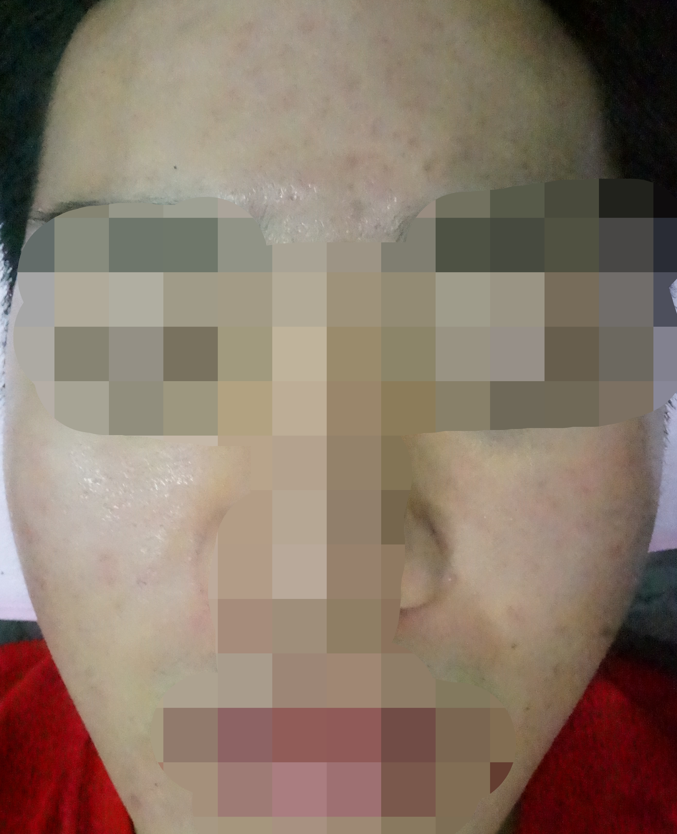 제주점 치료 후