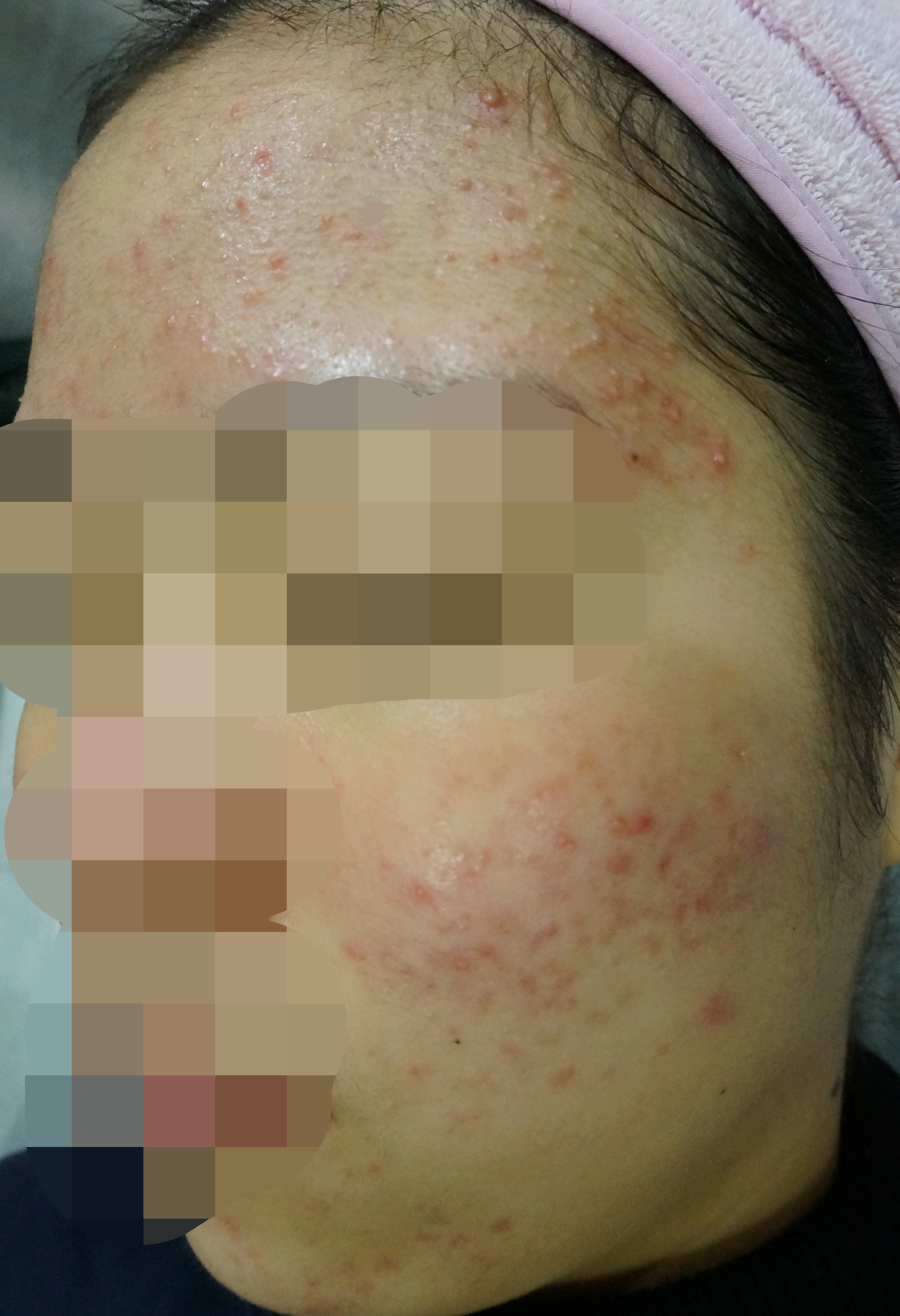 제주점 치료 전