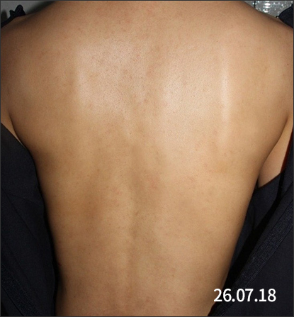 춘천점 치료 후