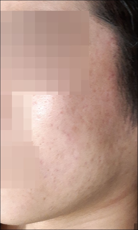 광주점 치료 후