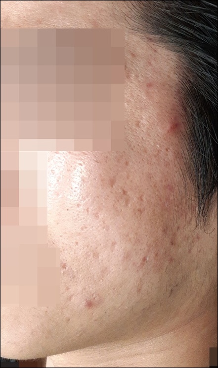 광주점 치료 전