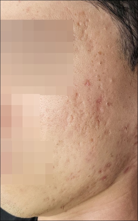 치료 전