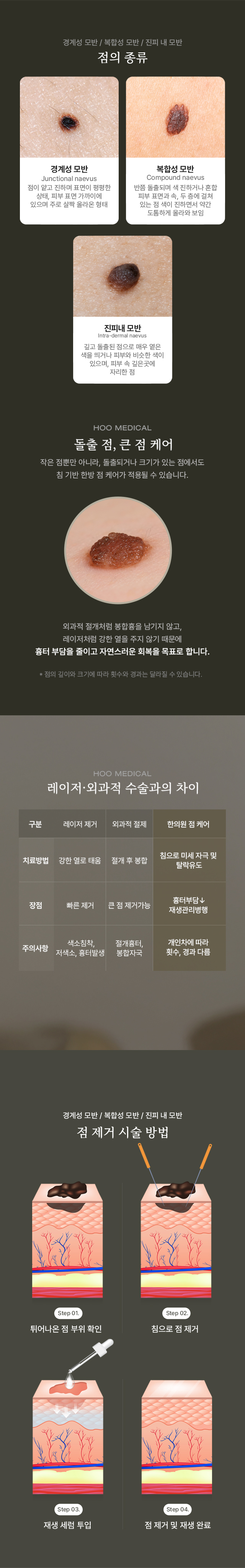 점 제거